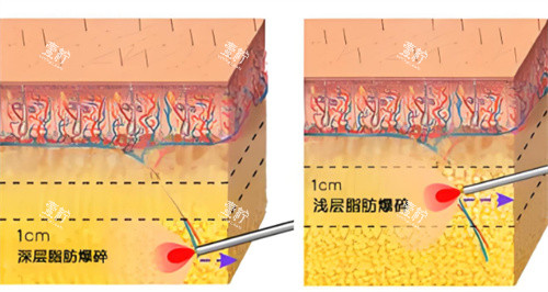 激光溶脂作用皮肤层图.jpg 激光溶脂作用皮肤层图.jpg