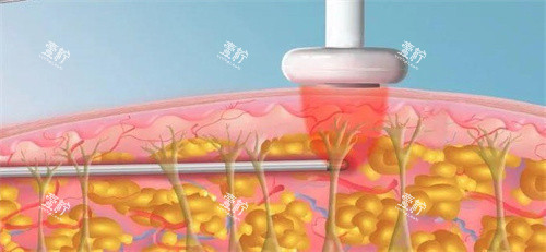 激光溶脂.jpg 激光溶脂.jpg