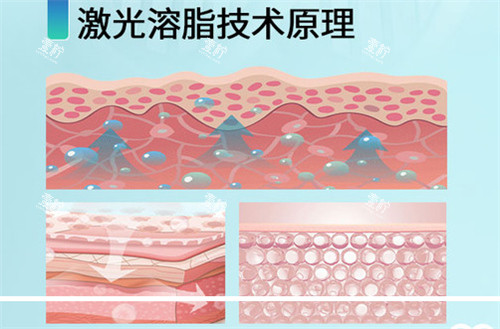 激光溶脂原理.jpg 激光溶脂原理.jpg