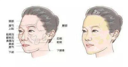 胶原蛋白面部填充前后.jpg 胶原蛋白面部填充前后.jpg