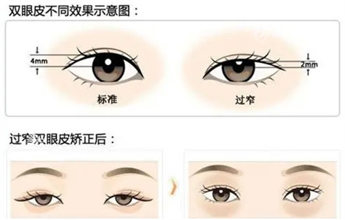 不同高度的双眼皮.jpg 不同高度的双眼皮.jpg