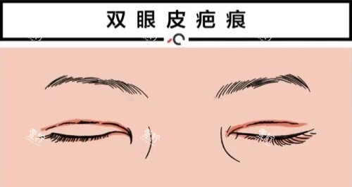 双眼皮疤痕修复动画图.JPG 双眼皮疤痕修复动画图.JPG