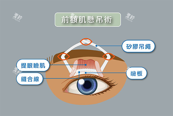 CFS额肌悬吊术怎么做的.jpg CFS额肌悬吊术怎么做的.jpg