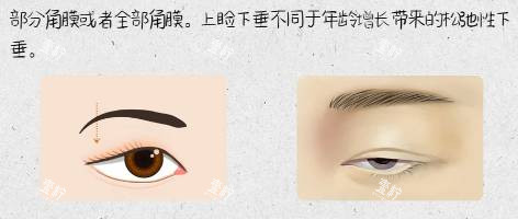 cfs额肌悬吊示意图.jpg cfs额肌悬吊示意图.jpg