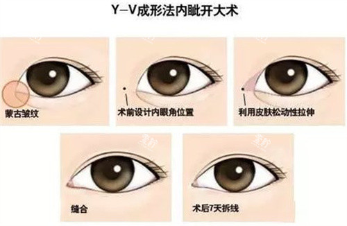 开眼角Y-V成型法.jpg 开眼角Y-V成型法.jpg