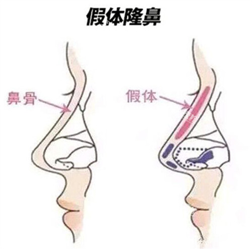 假体隆鼻对比.jpg