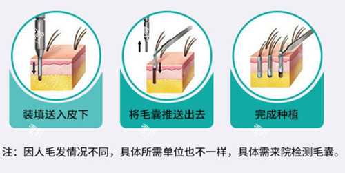 植发过程示意图片.jpg