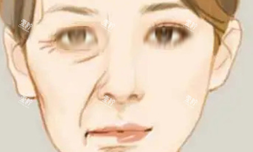 拉皮手术的对比动画图.jpg