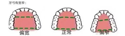 牙齿矫正牙弓形状.jpg 牙齿矫正牙弓形状.jpg