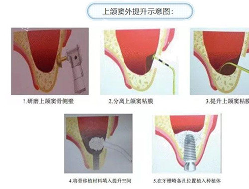 上颌窦提升过程.jpg