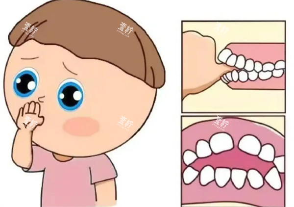 儿童牙齿正畸图.jpg