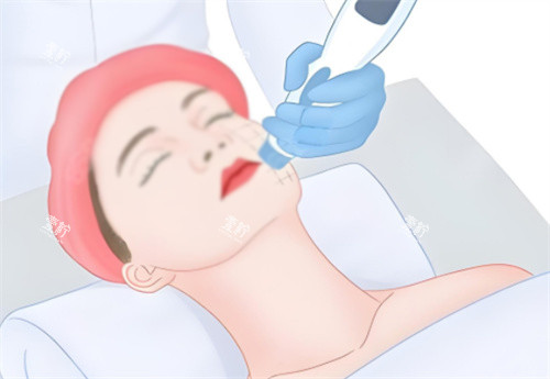 面部热玛吉.jpg 面部热玛吉.jpg