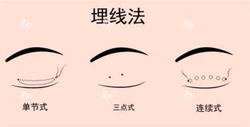 埋线双眼皮经过.png 埋线双眼皮经过.png