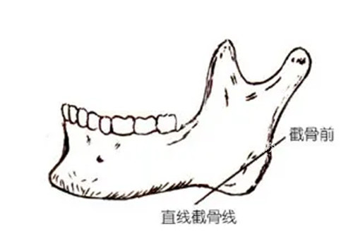 下颌角截骨简笔 下颌角截骨简笔