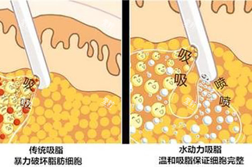 吸脂示意图.jpg 吸脂示意图.jpg