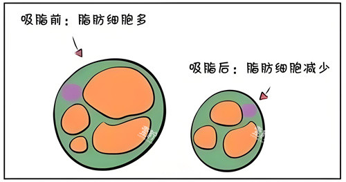 吸脂前后脂肪细胞对比动画图.jpg 吸脂前后脂肪细胞对比动画图.jpg