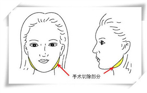 下颌角截骨手术.jpg 下颌角截骨手术.jpg