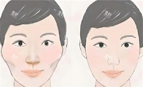 颧骨内推术前后对比动画图.jpg 颧骨内推术前后对比动画图.jpg