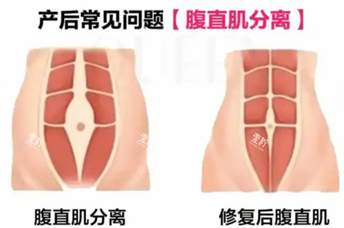 腹直肌修复漫画图.jpg 腹直肌修复漫画图.jpg