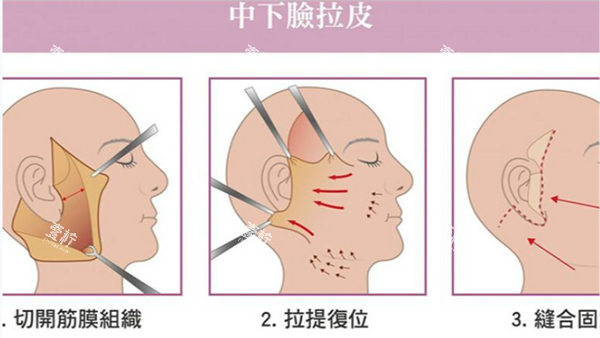 面部拉皮手术.png 面部拉皮手术.png