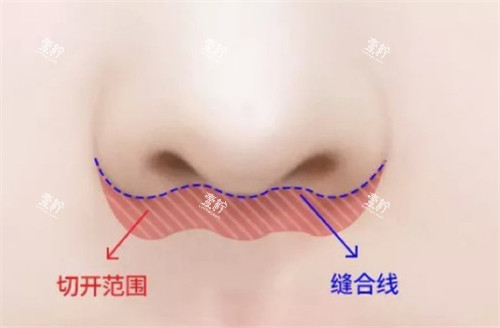 埋线人中缩短术手术位置图解.jpg