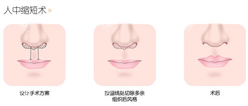 人中缩短术.jpg