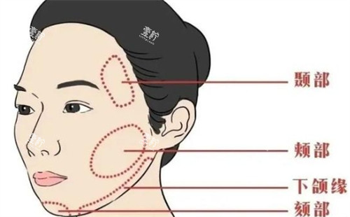 面部提升可以提升的区域.jpg
