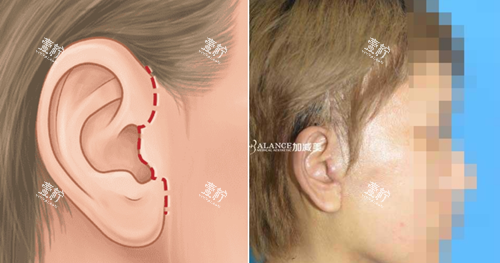 北京加减美v9手术优势不留疤痕.png