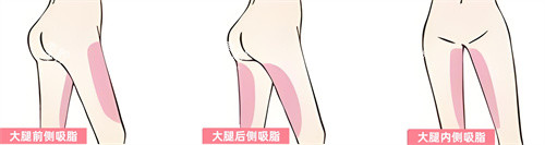 腿部吸脂部位展示动画图.jpg