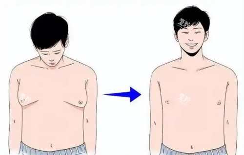 男性乳房发育吸脂前后示意图.jpg