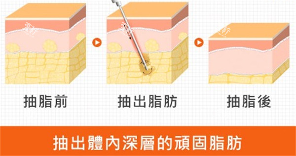 吸脂前后区别.jpg