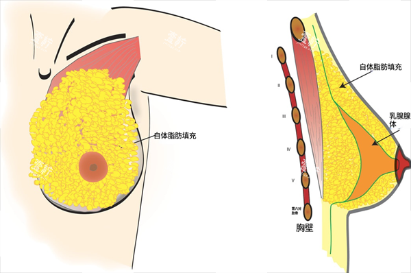 自体脂肪填充隆胸内部图.png