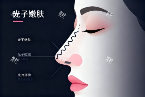 面部做光子嫩肤卡通图.jpg 面部做光子嫩肤卡通图.jpg