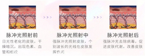 光子嫩肤对比.jpg 光子嫩肤对比.jpg