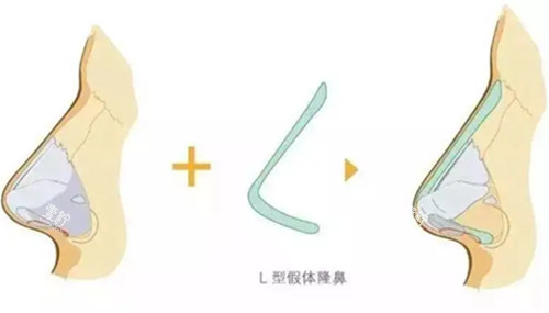 L型假体隆鼻步骤示意图.jpg L型假体隆鼻步骤示意图.jpg