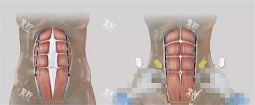 美人鱼腹壁成形术的过程.png 美人鱼腹壁成形术的过程.png
