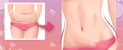 腹壁成形手术对比图.jpg 腹壁成形手术对比图.jpg