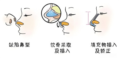 鼻综合手术过程动画.jpg