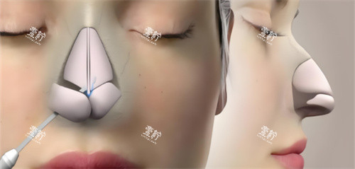 鼻综合鼻骨动画.jpg