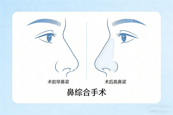 鼻综合手术成效图.jpg