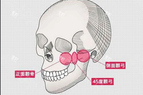 颧骨颧弓大概位置示意图.jpg 颧骨颧弓大概位置示意图.jpg