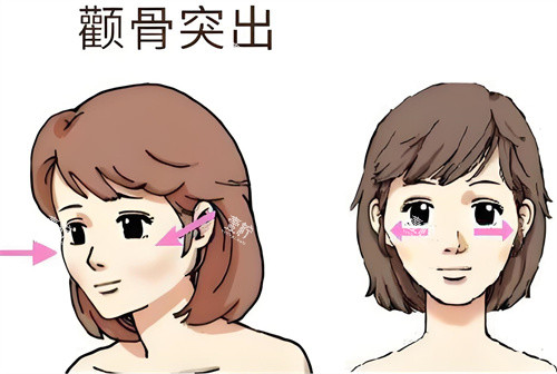 颧骨突出动画演示图.jpg 颧骨突出动画演示图.jpg
