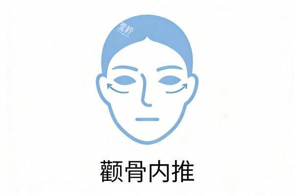 颧骨内推图片展示.jpg 颧骨内推图片展示.jpg