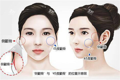 颧骨高突出演示动画图.jpg 颧骨高突出演示动画图.jpg