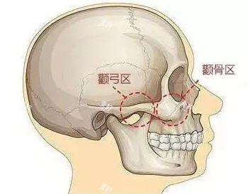 颧骨部位图.jpg 颧骨部位图.jpg