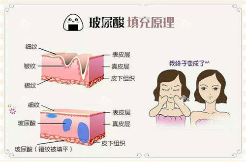 玻尿酸注射填充原理动画演示图.jpg