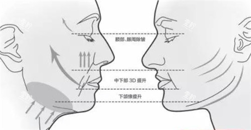 面部提升前后各个部位的对比.jpg