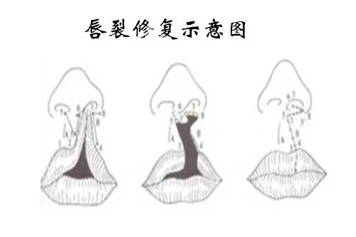 唇裂修复示意图.webp.jpg