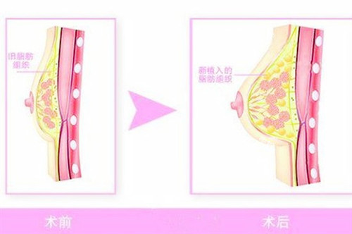 自体脂肪隆胸图片.jpg