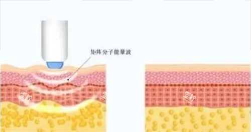 热玛吉项目皮肤剖面图.png 热玛吉项目皮肤剖面图.png